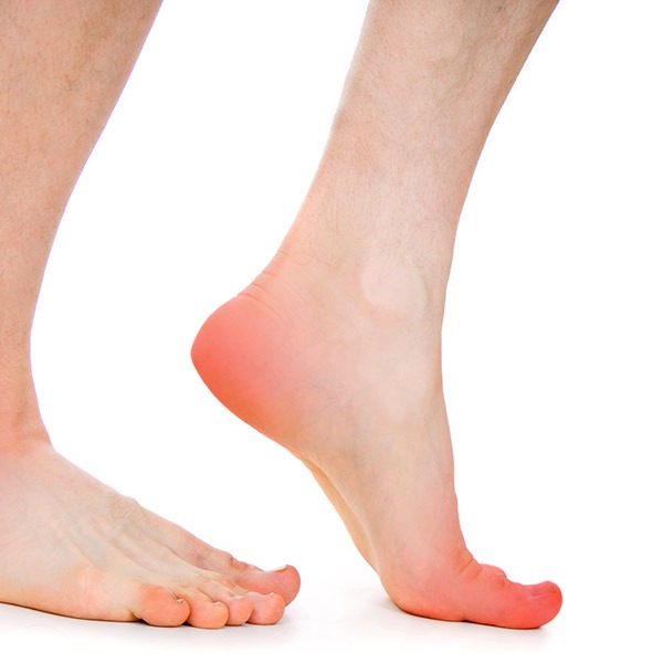 Plantar Fasciitis | Chiropractical | SW Calgary | Chiropractor